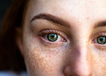 Κηλίδες στο πρόσωπο: Γιατί εμφανίζονται και πώς θα τις αντιμετωπίσουμε;