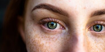 Alldaynews.gr Κηλίδες στο πρόσωπο: Γιατί εμφανίζονται και πώς θα τις αντιμετωπίσουμε;