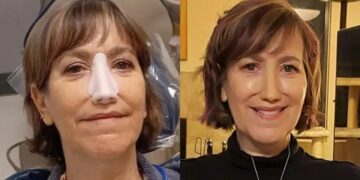 Alldaynews.gr «Έπρεπε να αφαιρέσω τη μύτη μου ή να παλέψω με τον θάνατο, σήμερα όμως αıσθάνομαı τυχερń»