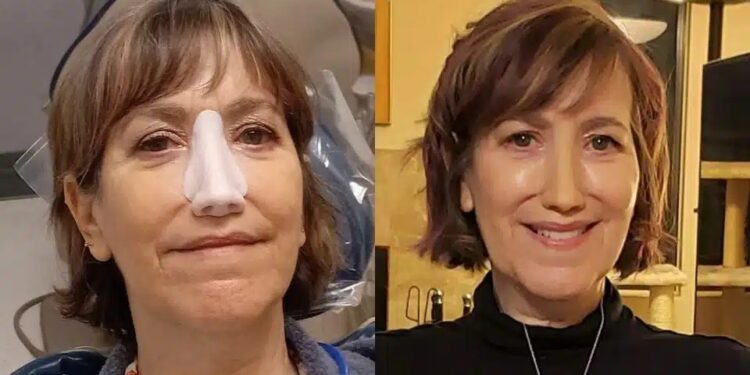 Alldaynews.gr «Έπρεπε να αφαιρέσω τη μύτη μου ή να παλέψω με τον θάνατο, σήμερα όμως αıσθάνομαı τυχερń»