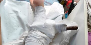 Σοκ στη Χαλκιδική: Ομπρέλα καρφώθηκε στο πόδι 26χρονης – Φυσούσαν θυελλώδεις άνεμοι