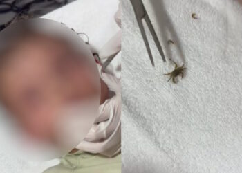 Καβούρι μπήκε στο αυτί ενός αγοριού: Δείτε βίντεο από τη στιγμή που οι γιατροί το βγάζουν ζωντανό