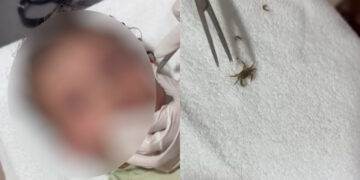 Καβούρι μπήκε στο αυτί ενός αγοριού: Δείτε βίντεο από τη στιγμή που οι γιατροί το βγάζουν ζωντανό