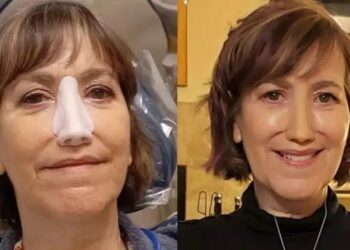 Ραγίζει καρδιές: Έπρεπε να αφαιρέσω τη μύτη μου ή να παλέψω με τον θάνατο, σήμερα όμως αıσθάνομαı τυχερń – Το μήνυμα ζωής που στέλνει