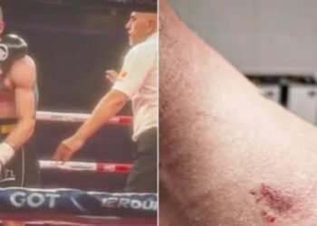 Alldaynews.gr Πρωτοφανές περιστατικό: Αλβανός πυγμάχος δάγκωσε Σέρβο αντίπαλό του και αντί να τιμωρηθεί, αναδείχθηκε νικητής!