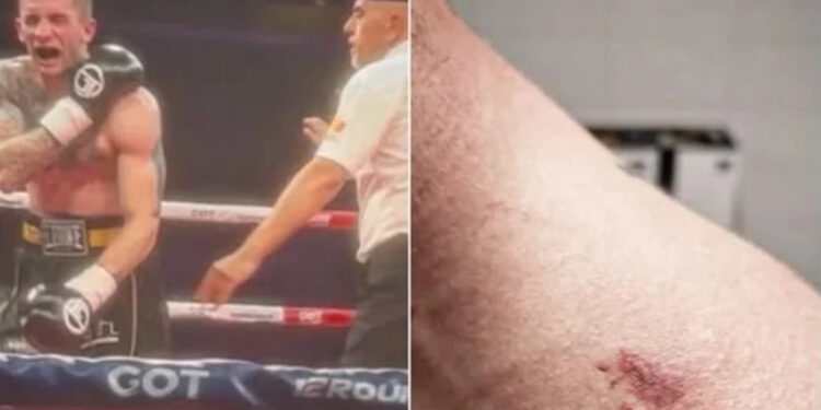 Πρωτοφανές περιστατικό: Αλβανός πυγμάχος δάγκωσε Σέρβο αντίπαλό του και αντί να τιμωρηθεί, αναδείχθηκε νικητής!