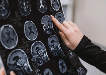 Νέα θεραπεία για το Αλτσχάιμερ καθαρίζει τον εγκέφαλο από πλάκες αμυλοειδούς-β μέσα σε λίγες ώρες