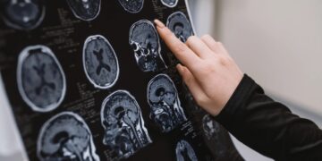 Alldaynews.gr Νέα θεραπεία για το Αλτσχάιμερ καθαρίζει τον εγκέφαλο από πλάκες αμυλοειδούς-β μέσα σε λίγες ώρες