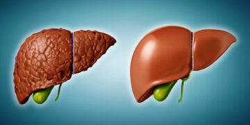 Λιπώδες ήπαρ: Το διατροφικό πλάνο που “καίει” το λίπος στο συκώτι και βοηθά σε ταχεία απώλεια βάρους