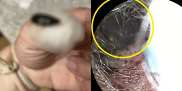 Alldaynews.gr «Οι γιατροί νόμιζαν ότι ήμουν υπό την επήρεια ναρκωτικών… αλλά τρομοκρατήθηκαν όταν κοίταξαν μέσα στο αυτί μου»