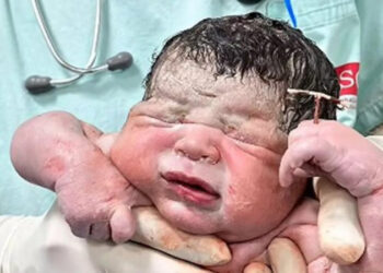 Απίστευτο: Νεογέννητο ήρθε στον κόσμο κρατώντας το … σπιράλ της μαμάς του στο χέρι!