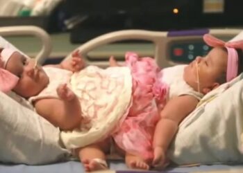 Τους είπαν ότι οι δίδυμες-σιαμαίες κόρες τους δεν θα περπατήσουν ποτέ – Σήμερα όμως…