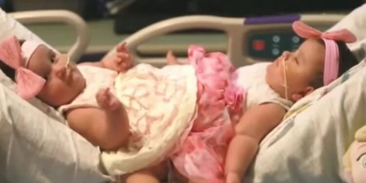 Alldaynews.gr Τους είπαν ότι οι δίδυμες-σιαμαίες κόρες τους δεν θα περπατήσουν ποτέ – Σήμερα όμως…