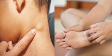 Λέμφωμα: Τα πρώιμα και αθώα συμπτώματα στο σώμα που σπάνια εντοπίζονται εγκαίρως