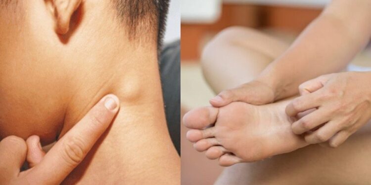 Λέμφωμα: Τα πρώιμα και αθώα συμπτώματα στο σώμα που σπάνια εντοπίζονται εγκαίρως