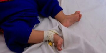 Τραγωδία: Μωρό 13 μηνών υπέστη καρδιακή προσβολή και έκαψε τη μισή του γλώσσα – Ρούφηξε το αποφρακτικό μπουκάλι σαν μπιμπερό