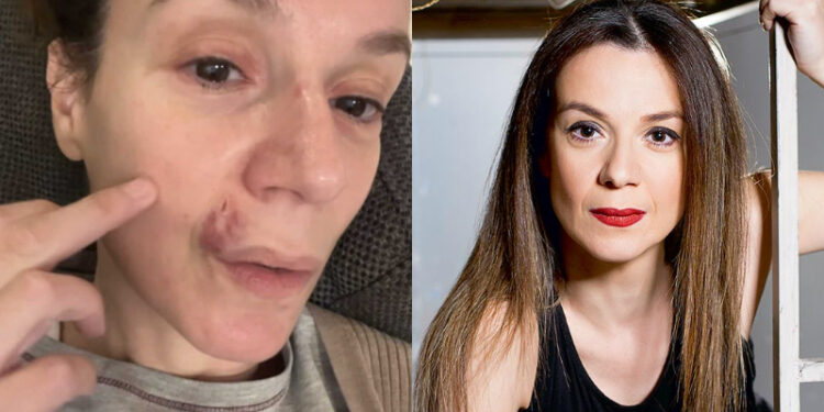 Alldaynews.gr Με μαυρισμένο μάτι, μελανιές και αίματα στο πρόσωπο η Πέγκυ Τρικαλιώτη