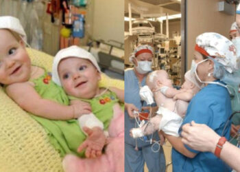 Οι Σιαμαίες που γεννήθηκαν το 2003: Η 24ωρη εγχείρηση που άλλαξε τη ζωή τους – Πώς είναι σήμερα; (ΦΩΤΟ)