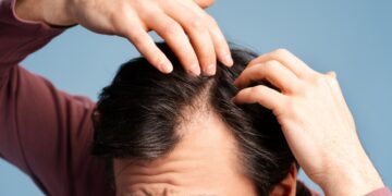 Τριχόπτωση στους άνδρες: Γιατί συμβαίνει και πώς βοηθά το Androxil