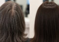 Γκρίζα μαλλιά: Επιστήμονες ανέπτυξαν ενέσεις που επαναφέρουν το φυσικό χρώμα