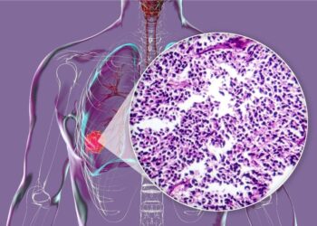 Μικροκυτταρικός και μη μικροκυτταρικός καρκίνος πνεύμονα: Ποιες είναι οι διαφορές και γιατί έχουν σημασία