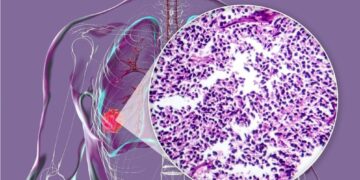 Μικροκυτταρικός και μη μικροκυτταρικός καρκίνος πνεύμονα: Ποιες είναι οι διαφορές και γιατί έχουν σημασία