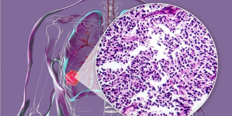 Μικροκυτταρικός και μη μικροκυτταρικός καρκίνος πνεύμονα: Ποιες είναι οι διαφορές και γιατί έχουν σημασία