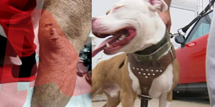 Αδιανόητο: Νεαρός έβαλε το πίτμπουλ του να επιτεθεί σε 30χρονο για να τον ληστέψει – «Με έριξε κάτω και το σκυλί με δάγκωνε» (video)