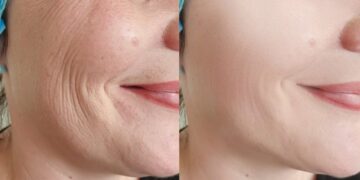 Μπότοξ της φύσης: 8 τροφές για αναπλήρωση του κολλαγόνου στο δέρμα και μείωση των ρυτίδων με φυσικό τρόπο