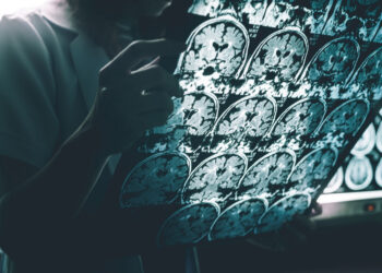 Κοινό φάρμακο θα μπορούσε να σταματήσει τη νόσο Αλτσχάιμερ «πριν καν ξεκινήσει» (φωτο)