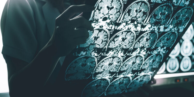 Alldaynews.gr Κοινό φάρμακο θα μπορούσε να σταματήσει τη νόσο Αλτσχάιμερ «πριν καν ξεκινήσει»