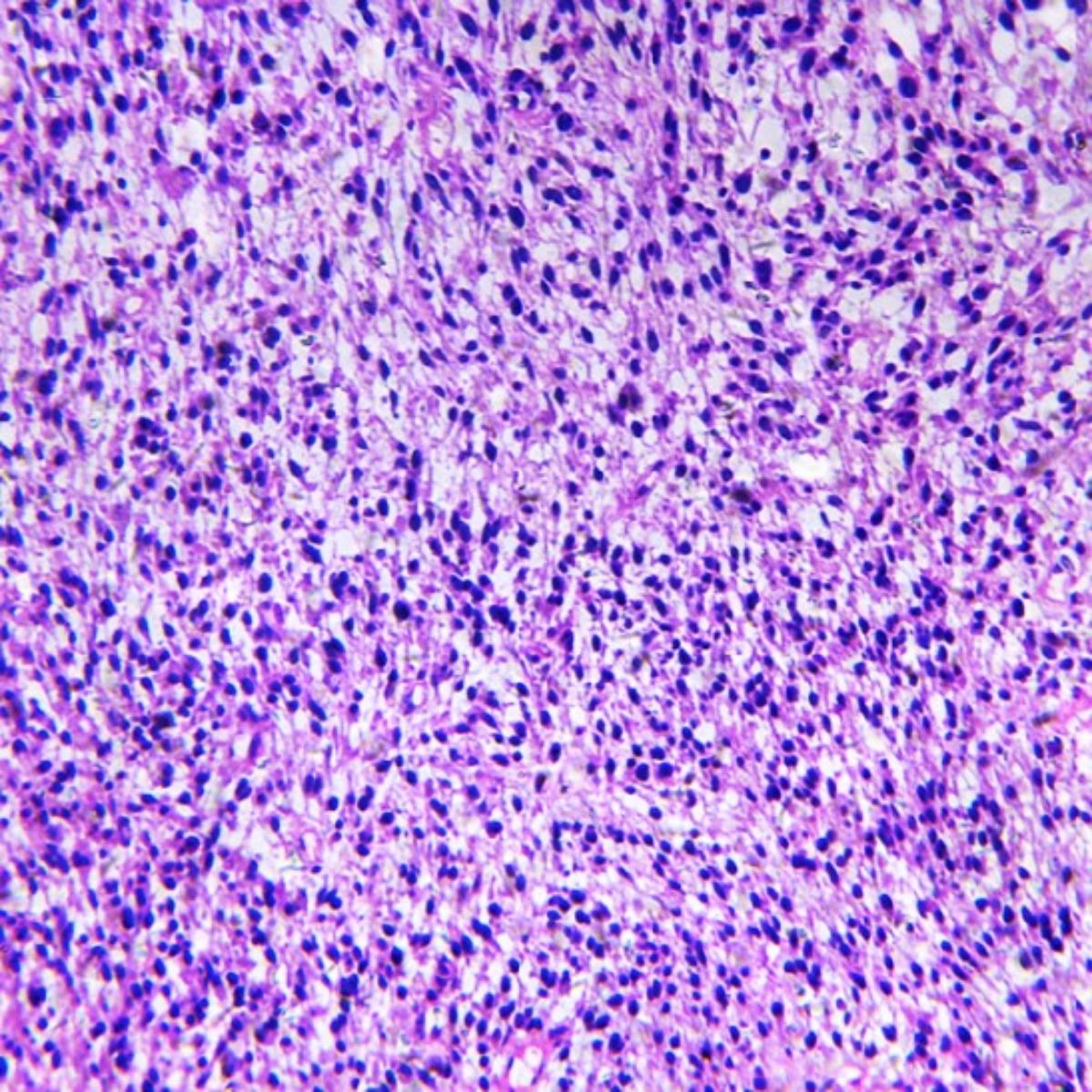 Τι είναι το Κυψελιδικό Ραβδομυοσάρκωμα