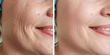 Μπότοξ της φύσης: 8 τροφές για αναπλήρωση του κολλαγόνου στο δέρμα και μείωση των ρυτίδων με φυσικό τρόπο