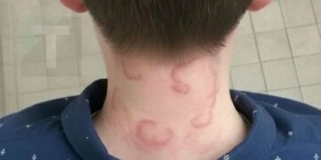 Ο 8χρονος γιος μου έχει αυτό εδώ και 2 μήνες συνεχόμενα και έχει χειροτερέψει από την πρώτη φορά που το είχε… Τι είναι;