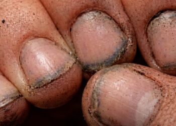 Τι πραγματικά λένε τα βρώμικα νύχια για έναν άνθρωπο;