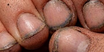 Τι πραγματικά λένε τα βρώμικα νύχια για έναν άνθρωπο;