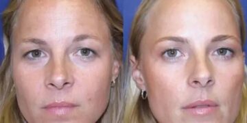 Μελέτη για το botox: Αποκαλυπτικές φωτό σε πανομοιότυπες δίδυμες δείχνουν τι προκαλεί σε 13 χρόνια