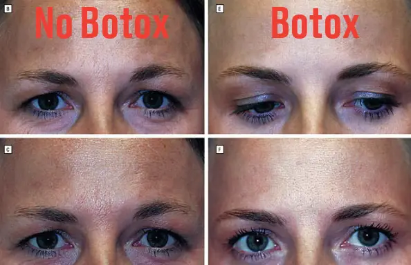 Alldaynews.gr Μελέτη για το botox: Αποκαλυπτικές φωτό σε πανομοιότυπες δίδυμες δείχνουν τι προκαλεί σε 20 χρόνια