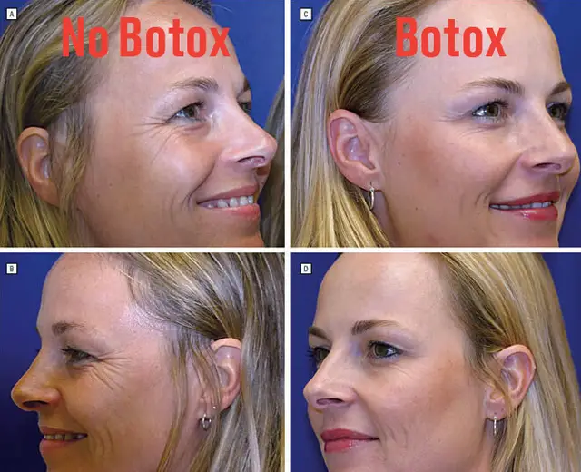 Alldaynews.gr Μελέτη για το botox: Αποκαλυπτικές φωτό σε πανομοιότυπες δίδυμες δείχνουν τι προκαλεί σε 20 χρόνια