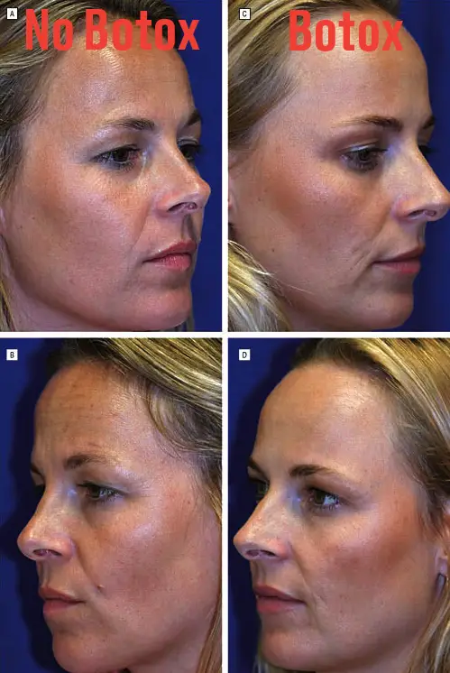 Alldaynews.gr Μελέτη για το botox: Αποκαλυπτικές φωτό σε πανομοιότυπες δίδυμες δείχνουν τι προκαλεί σε 20 χρόνια