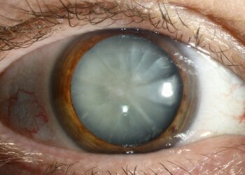 Καταρράκτης ματιών: τι είναι, πρώτα συμπτώματα, επέμβαση και σύγχρονη θεραπεία