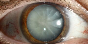 Καταρράκτης ματιών: τι είναι, πρώτα συμπτώματα, επέμβαση και σύγχρονη θεραπεία