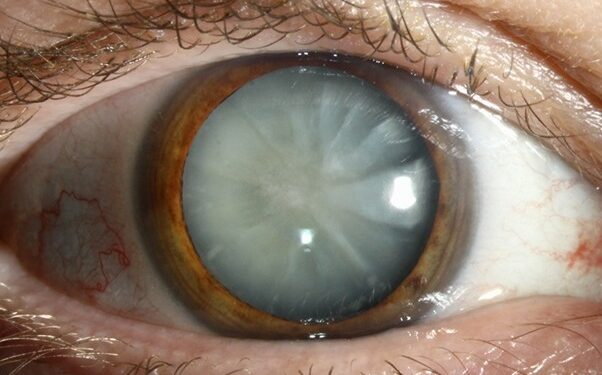 Καταρράκτης ματιών: τι είναι, πρώτα συμπτώματα, επέμβαση και σύγχρονη θεραπεία