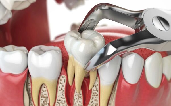 Εξαγωγή δοντιού: διαδικασία, παρενέργειες, ανάρρωση και πότε κλείνει η πληγή