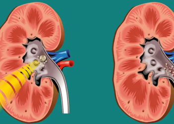 Αντιμετωπίστε την ουρολιθίαση με λιθοτριψία με λέιζερ!