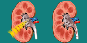 Αντιμετωπίστε την ουρολιθίαση με λιθοτριψία με λέιζερ!
