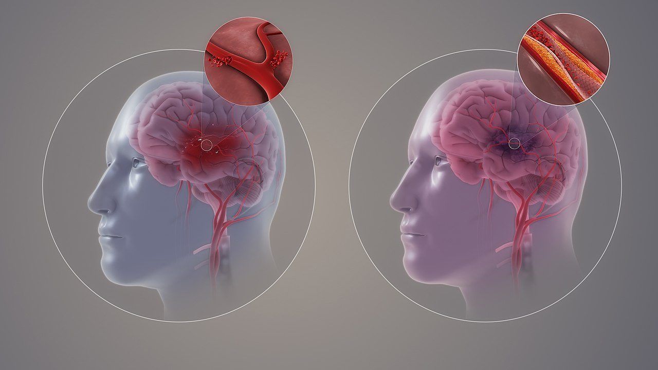 1280pxstroke e1600188080554 3eb97122