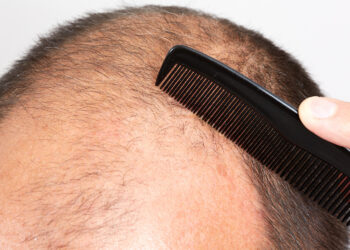 Τέλος η φαλάκρα; Ορός-«θαύμα» φέρνει τα πάνω κάτω στην ανάπτυξη μαλλιών