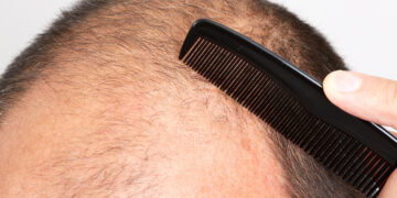 Τέλος η φαλάκρα; Ορός-«θαύμα» φέρνει τα πάνω κάτω στην ανάπτυξη μαλλιών