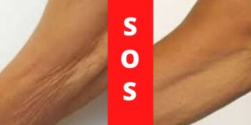 Γιατί τα μπράτσα «χαλαρώνουν» πιο εύκολα μετά τα 50 και τι μπορείτε να κάνετε;